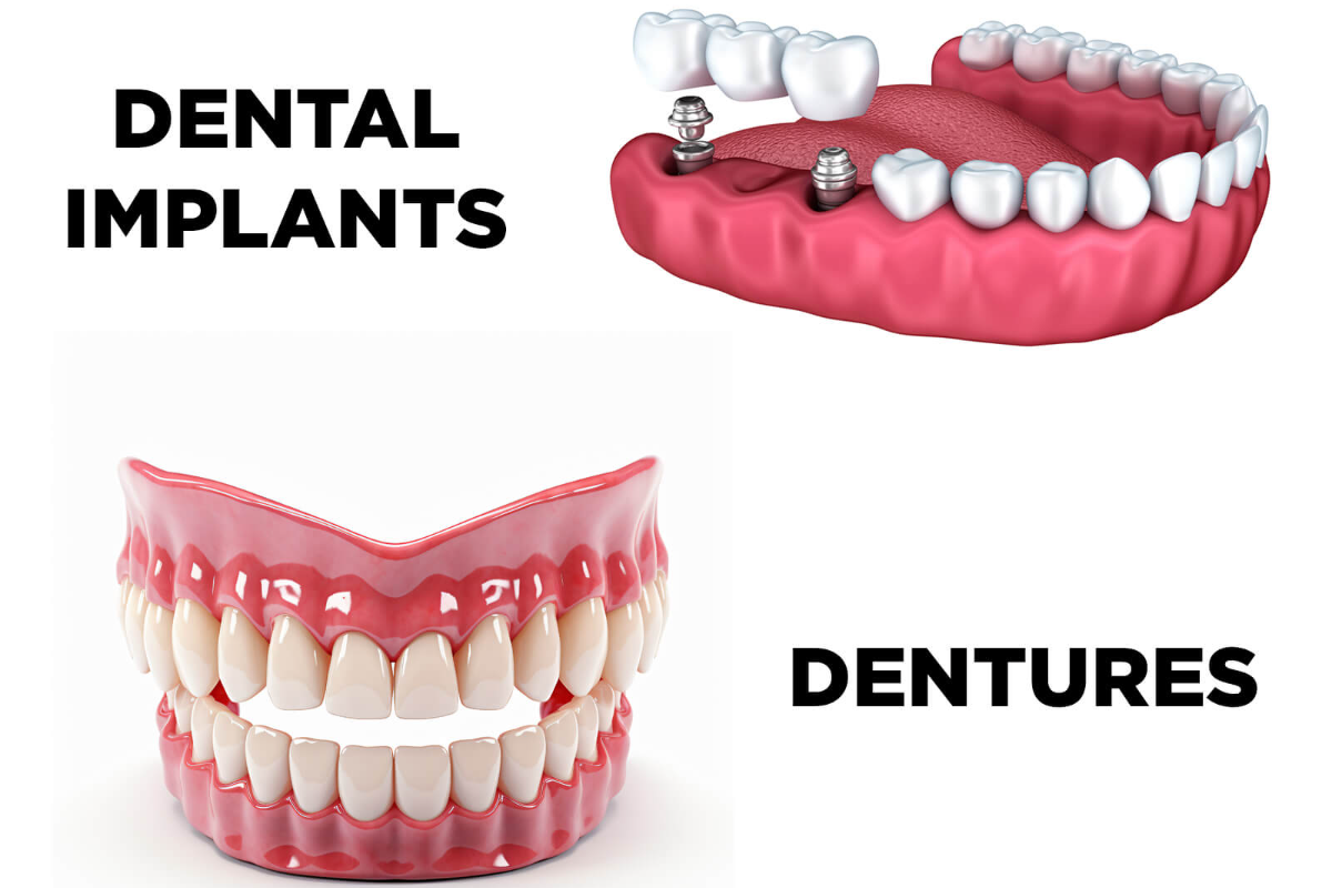 dental implants vs dentures which one is right for you