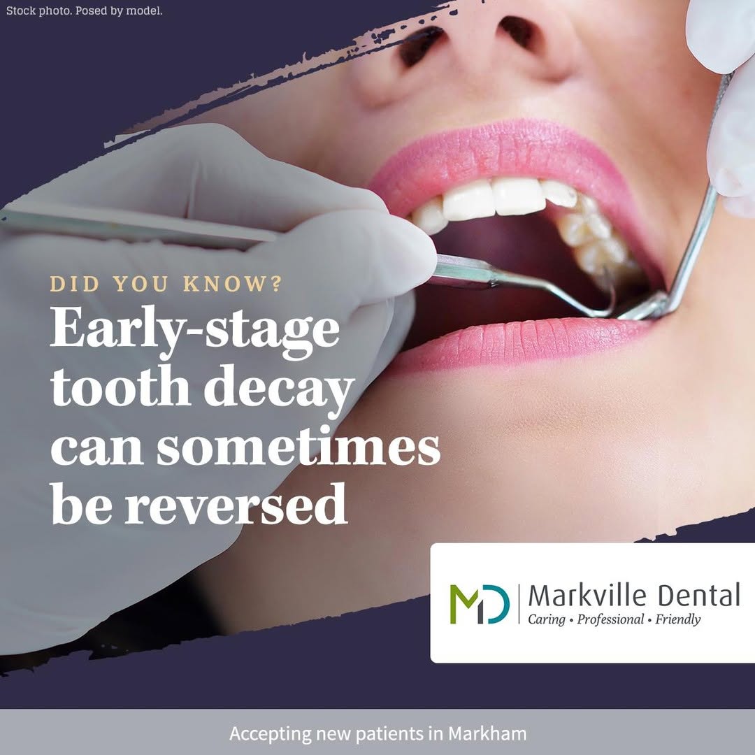 tooth decay explained by dentist in markham