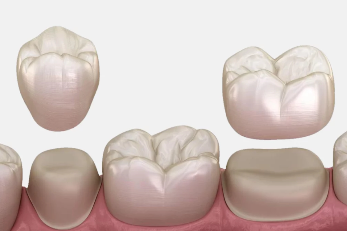 how soon can you start eating after getting dental crown
