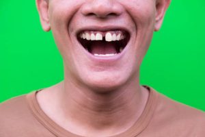 what happens if you don t replace missing teeth
