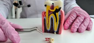 how long does a root canal take